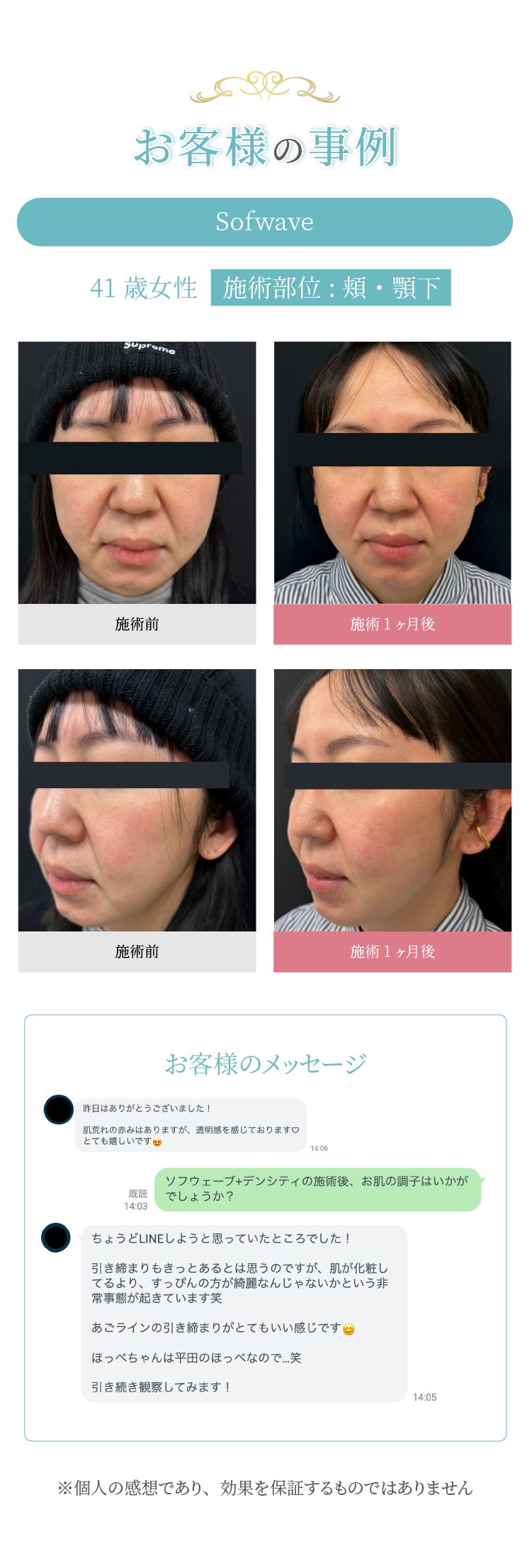 40代女性の頬・顎下のたるみ改善症例（施術前と1ヶ月後の比較）